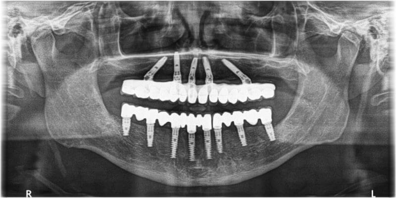 Full mouth Implant